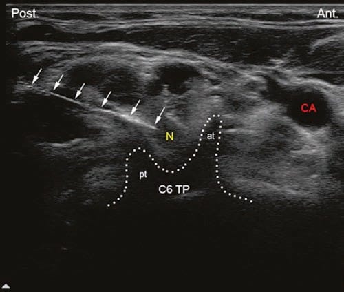 By moving the transducer cranially, the transverse process of the sixth ...